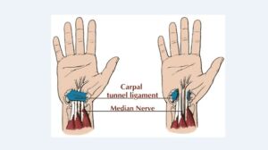 carpal tunnel syndrome